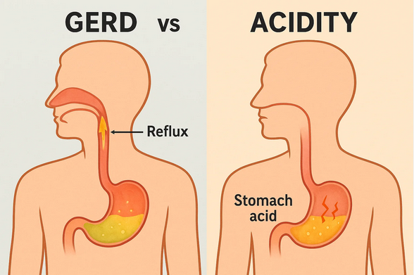 Acidity vs GERD: Are You Treating the Wrong Problem?
