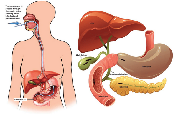 ERCP: What It Is, Why It’s Needed, and What Patients Should Know